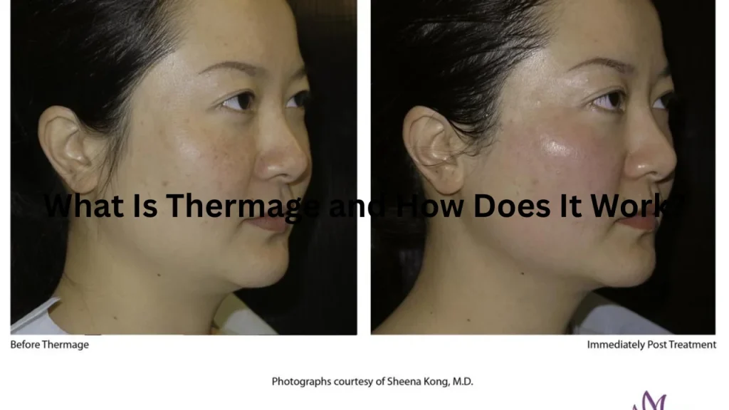 What Is Thermage and How Does It Work