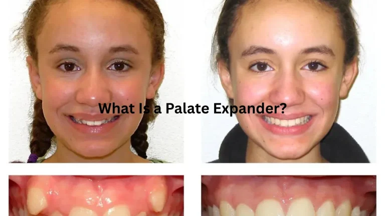 What Is a Palate Expander
