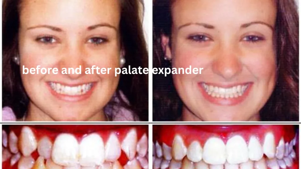 before and after palate expander