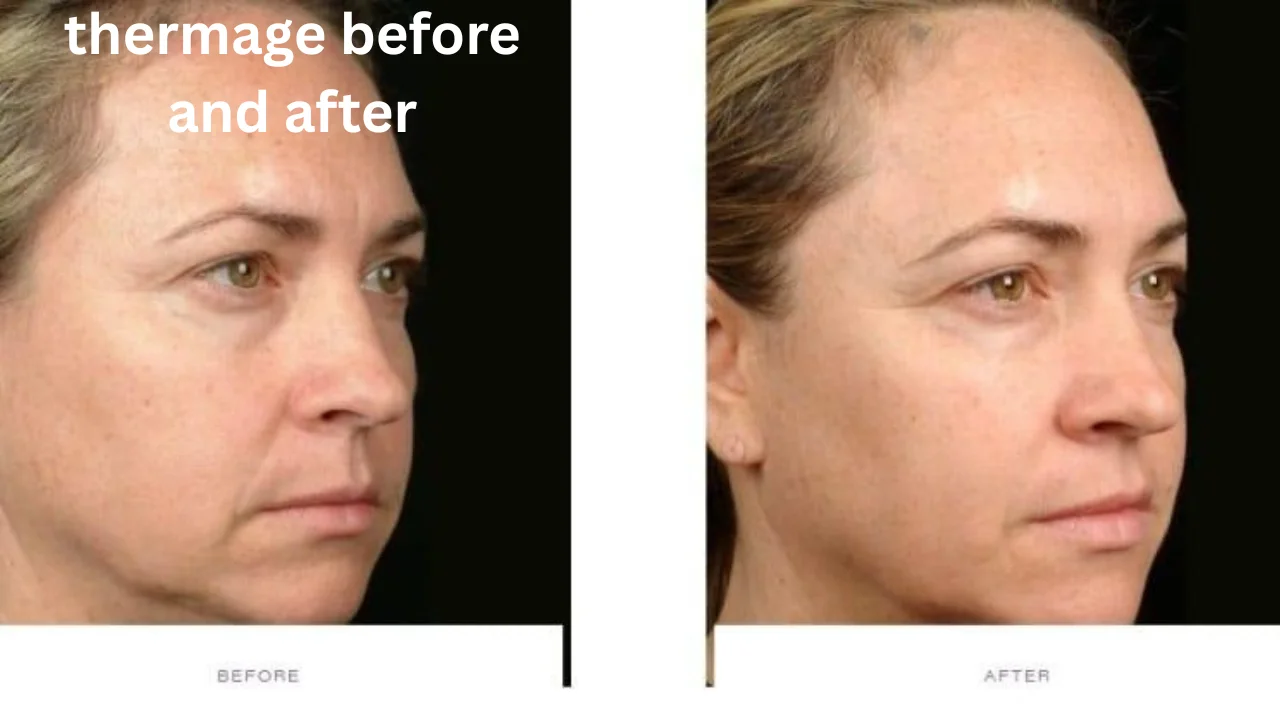 thermage before and after